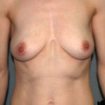 Breast Reconstruction Before & After Patient #1775