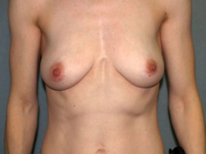 Breast Reconstruction Before & After Patient #1775