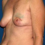 Breast Reconstruction Before & After Patient #2130