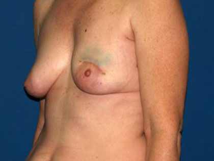 Breast Reconstruction Before & After Patient #2130