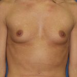 Breast Augmentation Before & After Patient #2822