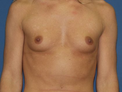 Breast Augmentation Before & After Patient #2822