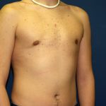 Gynecomastia Before & After Patient #927