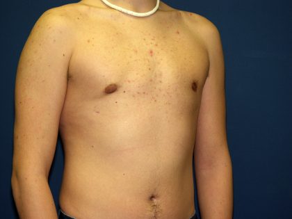 Gynecomastia Before & After Patient #927