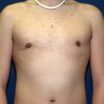 Gynecomastia Before & After Patient #927