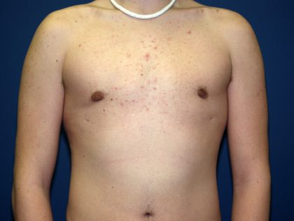 Gynecomastia Before & After Patient #927