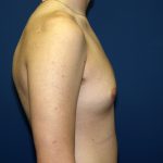 Gynecomastia Before & After Patient #927