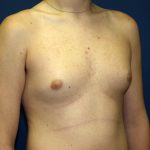 Gynecomastia Before & After Patient #927