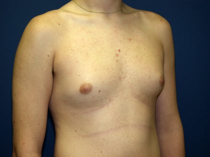 Gynecomastia Before & After Patient #927