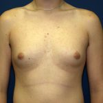 Gynecomastia Before & After Patient #927