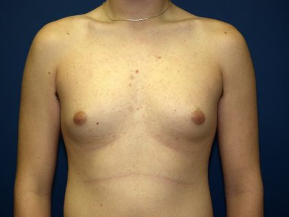 Gynecomastia Before & After Patient #927