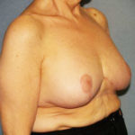 Breast Reduction Before & After Patient #3272