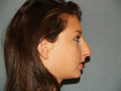 Nose Surgery Before & After Patient #759