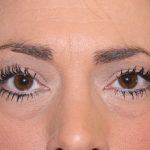 Eye Lid Lift Before & After Patient #698