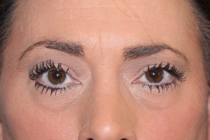 Eye Lid Lift Before & After Patient #698