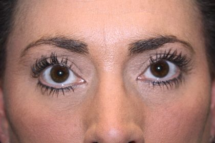 Eye Lid Lift Before & After Patient #698