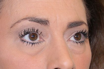 Eye Lid Lift Before & After Patient #698