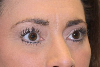 Eye Lid Lift Before & After Patient #698