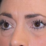 Eye Lid Lift Before & After Patient #698