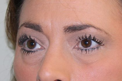 Eye Lid Lift Before & After Patient #698