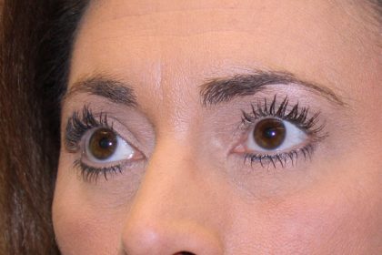 Eye Lid Lift Before & After Patient #698