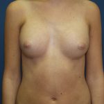 Breast Augmentation Before & After Patient #3074