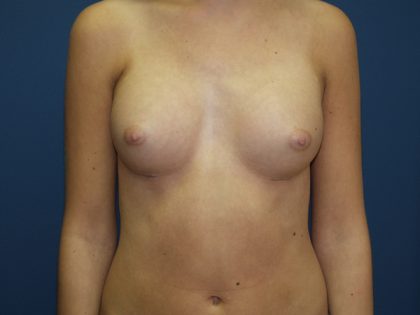 Breast Augmentation Before & After Patient #3074