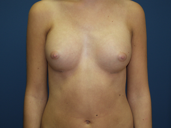 Breast Augmentation Before & After Patient #3074