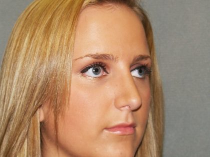 Nose Surgery Before & After Patient #812