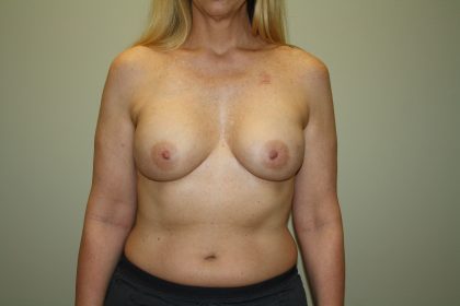 Breast Reconstruction Before & After Patient #2227