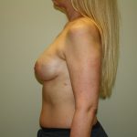 Breast Reconstruction Before & After Patient #2227