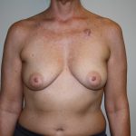 Breast Reconstruction Before & After Patient #2227