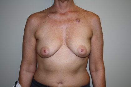 Breast Reconstruction Before & After Patient #2227