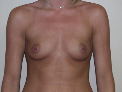 Breast Augmentation Before & After Patient #2983