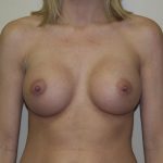Breast Augmentation Before & After Patient #2983
