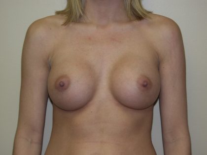 Breast Augmentation Before & After Patient #2983