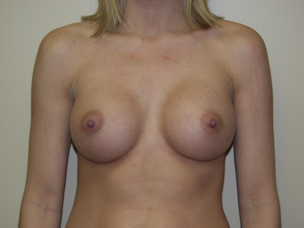 Breast Augmentation Before & After Patient #2983