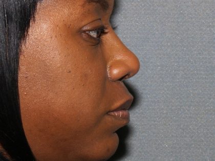 Nose Surgery Before & After Patient #819