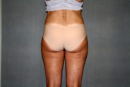 Liposuction Before & After Patient #3682