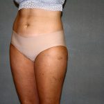 Liposuction Before & After Patient #3682