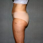 Liposuction Before & After Patient #3682