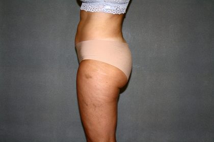 Liposuction Before & After Patient #3682