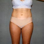 Liposuction Before & After Patient #3682
