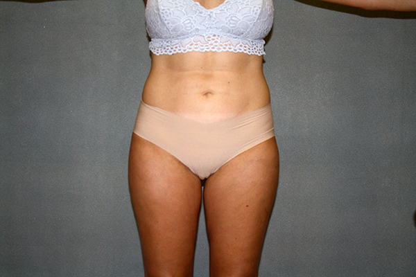 Liposuction Before & After Patient #3682