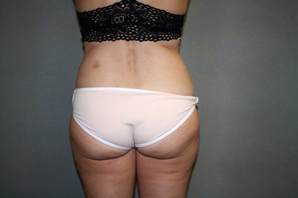 Liposuction Before & After Patient #3682