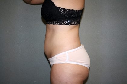 Liposuction Before & After Patient #3682