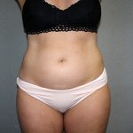 Liposuction Before & After Patient #3682