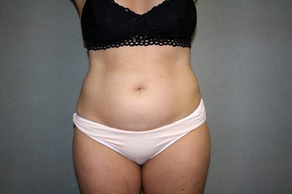 Liposuction Before & After Patient #3682