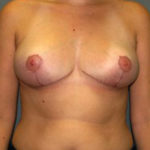 Breast Reduction Before & After Patient #3415