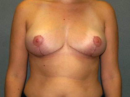 Breast Reduction Before & After Patient #3415